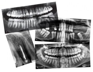 Radiografias dentales